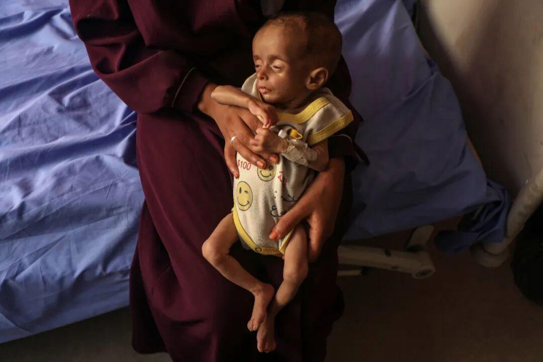 这是7月23日在加沙城一所医院里拍摄的营养不良的儿童。 新华社发(里泽克·阿卜杜勒贾瓦德摄)