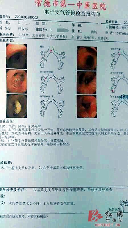 女子吃鸡爪骨头不慎卡在气管致肺部感染(图)