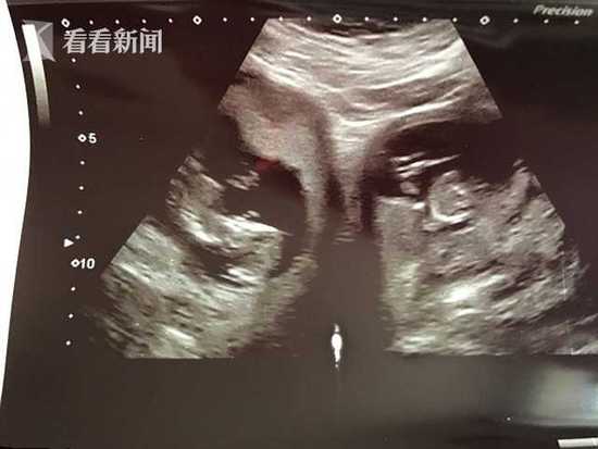怀孕双胞胎b超图图片